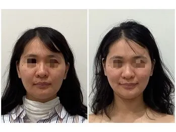美容鍼(before after)