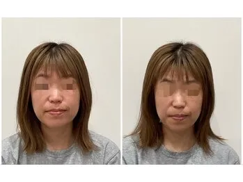  美容鍼(before after)