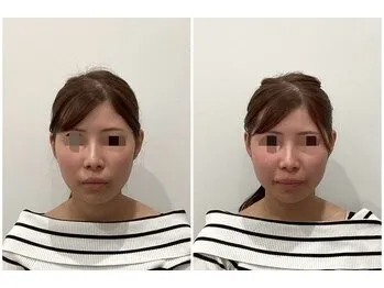 美容鍼(before after)