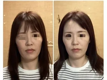美容鍼(before after)