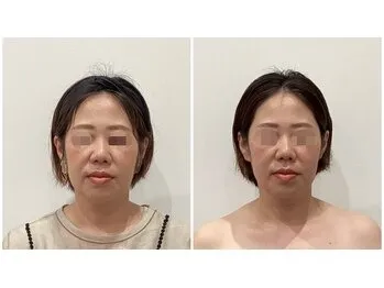 美容鍼(before after)