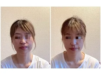 美容鍼(before after)